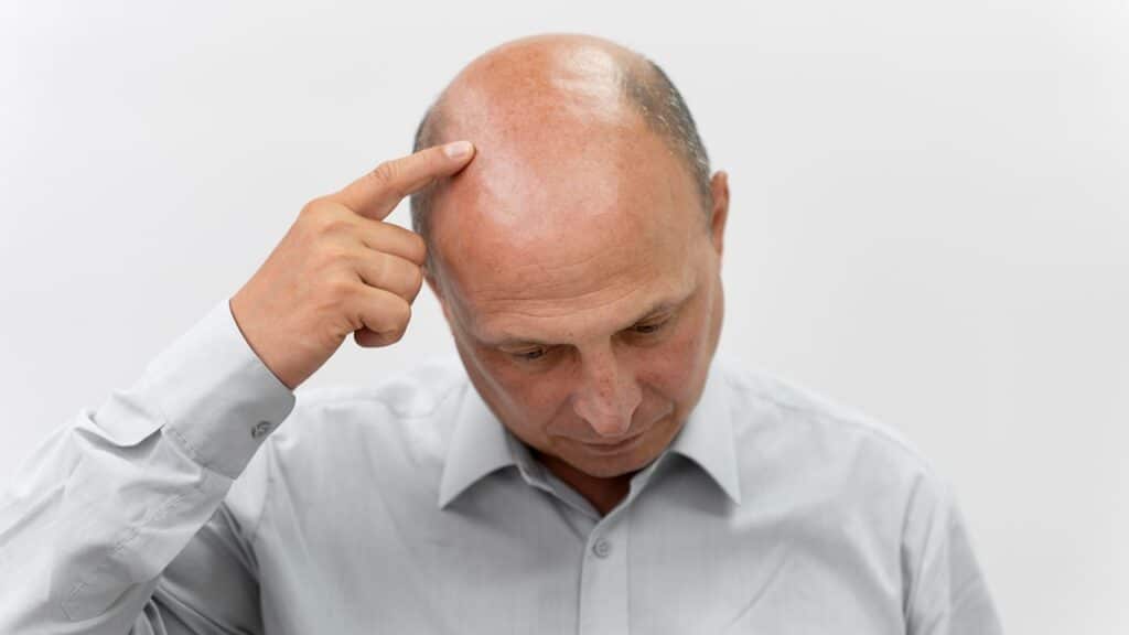 Pictures of Alopecia Hair Loss – Causes, Types, Treatments