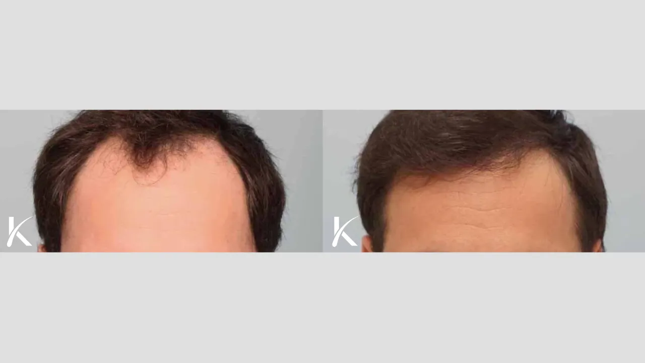 Hair-Transplant-Before-After-Photo-_-Male-Patient-1