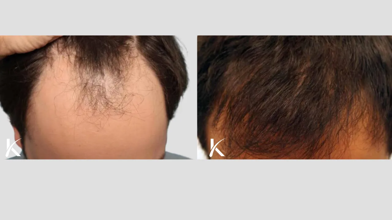 Hair-Transplant-Before-After-Photo-_-Male-Patient-2