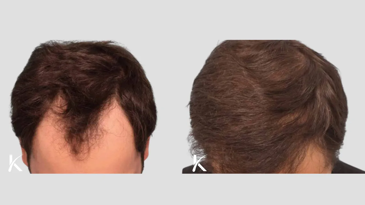 Hair-Transplant-Before-After-Photo-_-Male-Patient-3