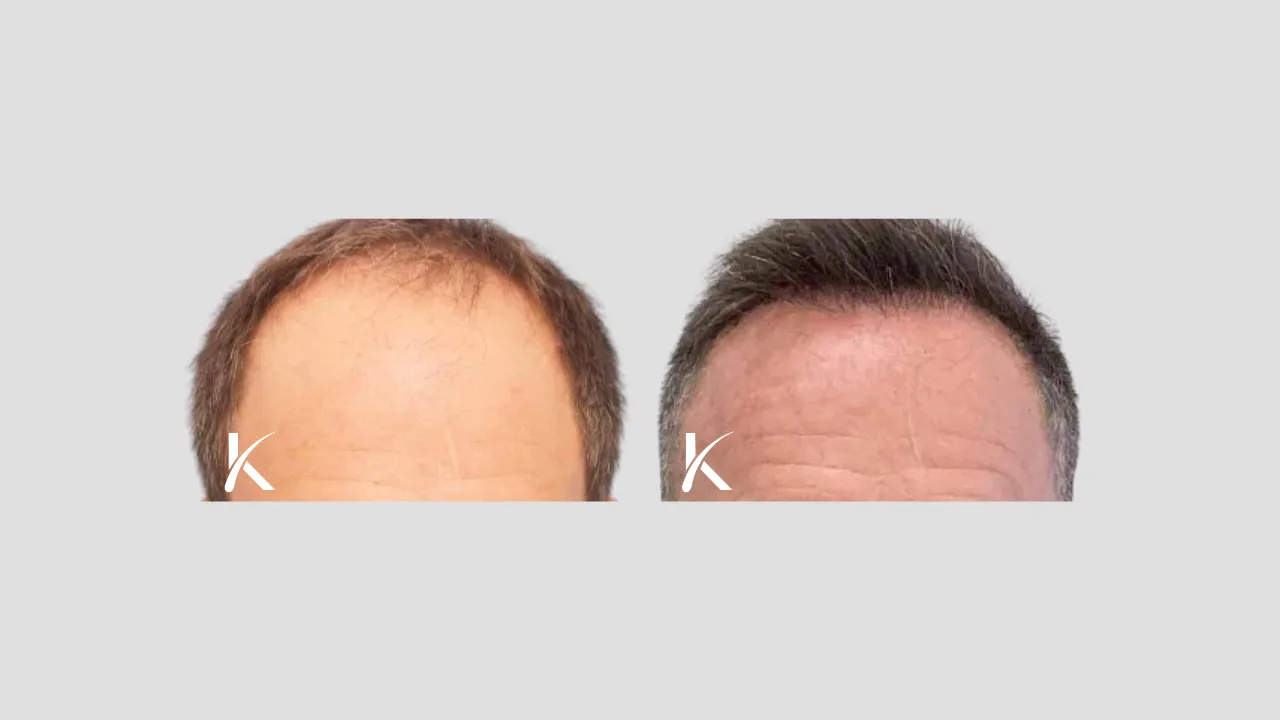 Hair-Transplant-Before-After-Photo-_-Male-Patient-4
