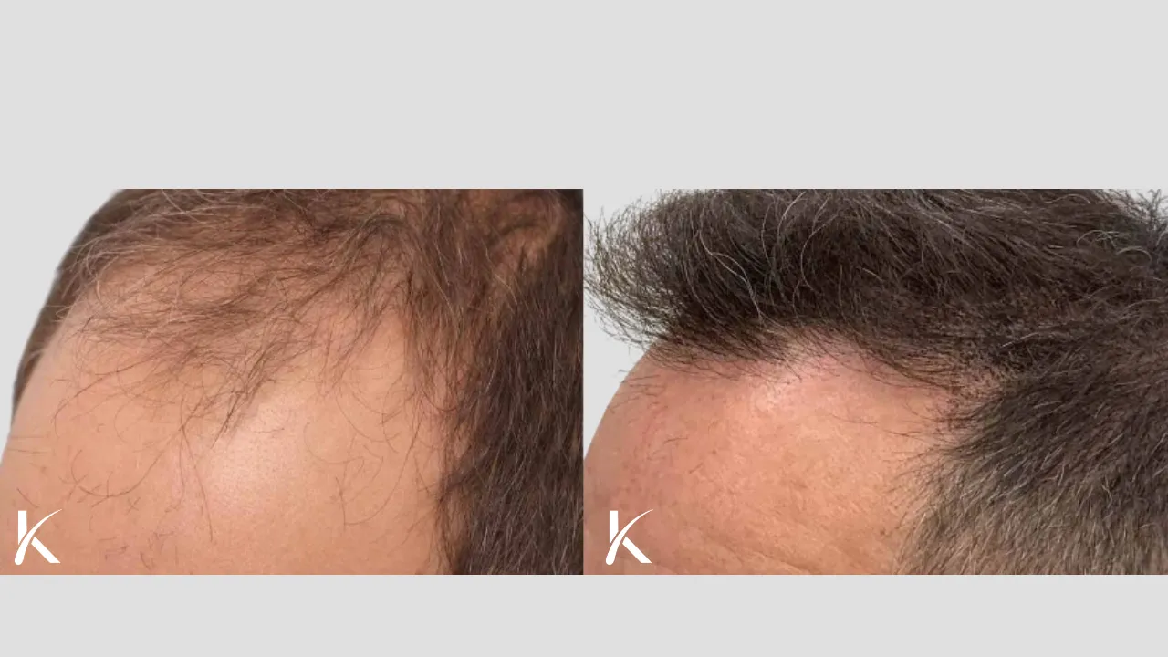 Hair-Transplant-Before-After-Photo-_-Male-Patient-6