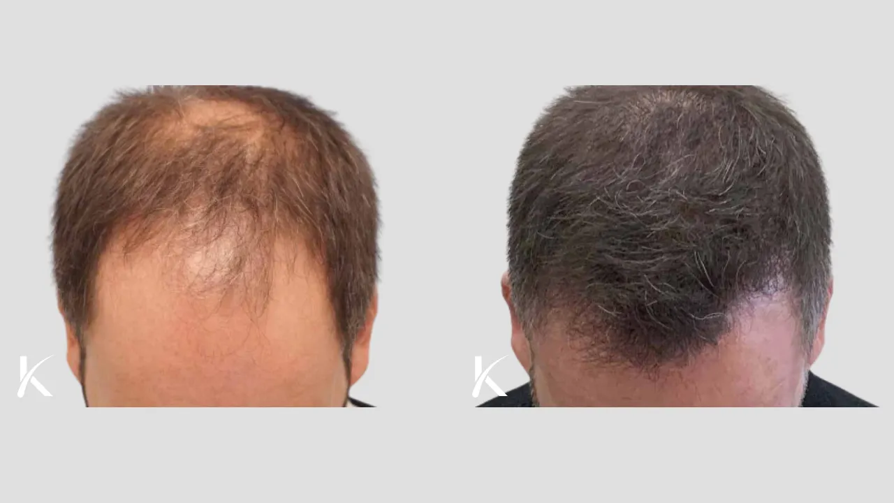 Hair-Transplant-Before-After-Photo-_-Male-Patient-7