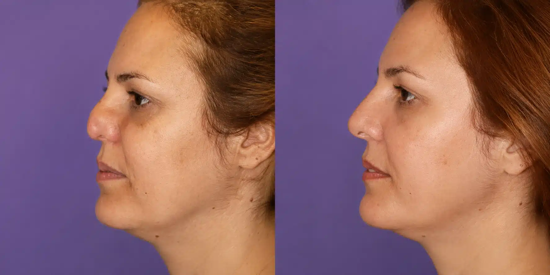 botched-surgery-before-and-after