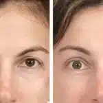 Brow-Lift-nj-1