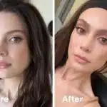 Brow-Lift-nj-2