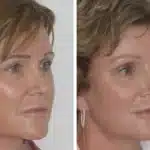 Brow-Lift-nj-4