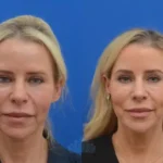 Brow-Lift-nj-5