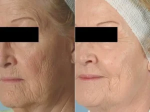 Microdermabrasion-before-and-after-1