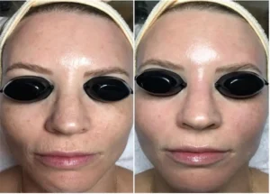 Microdermabrasion-before-and-after-2