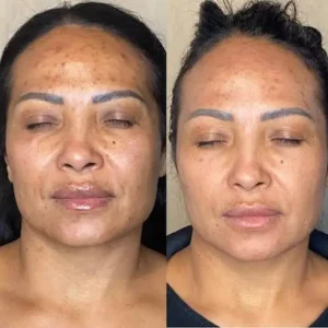 Microdermabrasion-before-and-after-3
