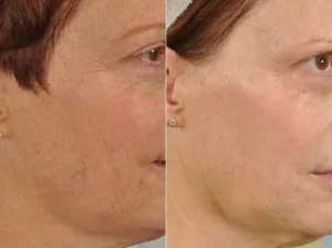 Microdermabrasion-before-and-after