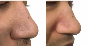 Microdermabrasion-before-and-after-4