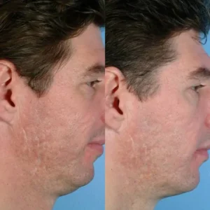 Microdermabrasion-before-and-after-5