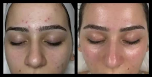 Microdermabrasion-before-and-after-6