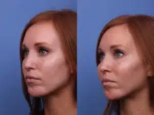 cheek-implants-before-and-after-1
