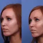 cheek-implants-before-and-after-1