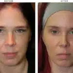 cheek-implants-before-and-after