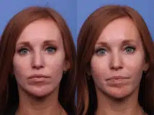 cheek-implants-before-and-after-2