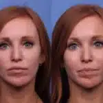 cheek-implants-before-and-after-2