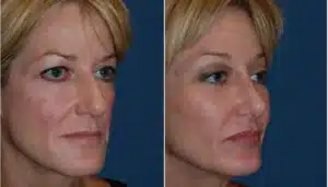 cheek-implants-before-and-after-3