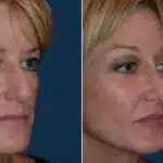 cheek-implants-before-and-after-3