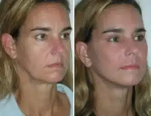 cheek-implants-before-and-after-4