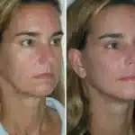 cheek-implants-before-and-after-4