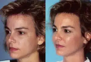 cheek-implants-before-and-after-5