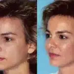 cheek-implants-before-and-after-5