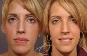 cheek-implants-before-and-after-6