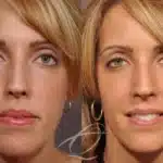 cheek-implants-before-and-after-6