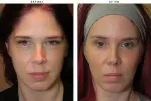 cheek-implants-before-and-after