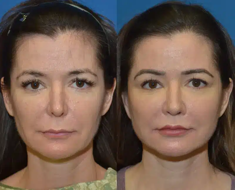 lip-lift-before-and-after-1