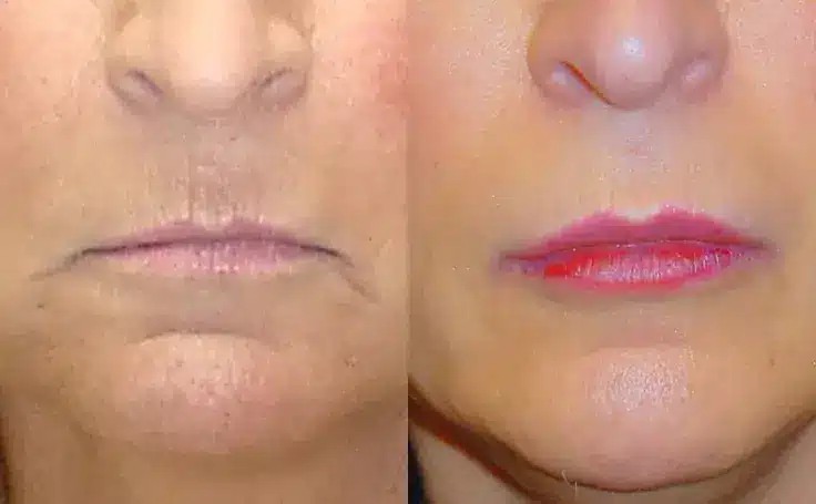 lip-lift-before-and-after-2
