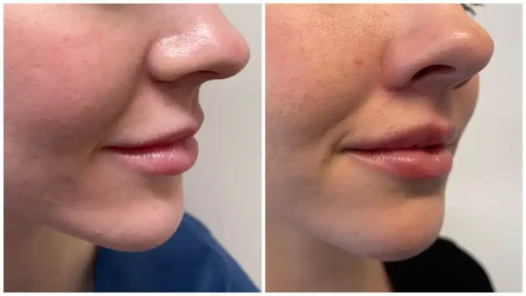 lip-lift-before-and-after-3