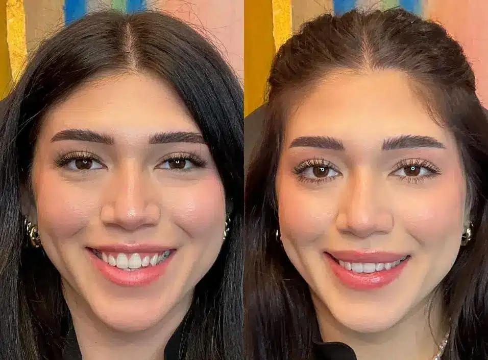 lip-lift-before-and-after-4