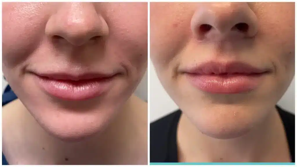 lip-lift-before-and-after-5