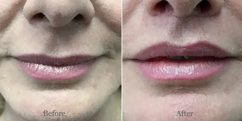 lip-lift-before-and-after-6