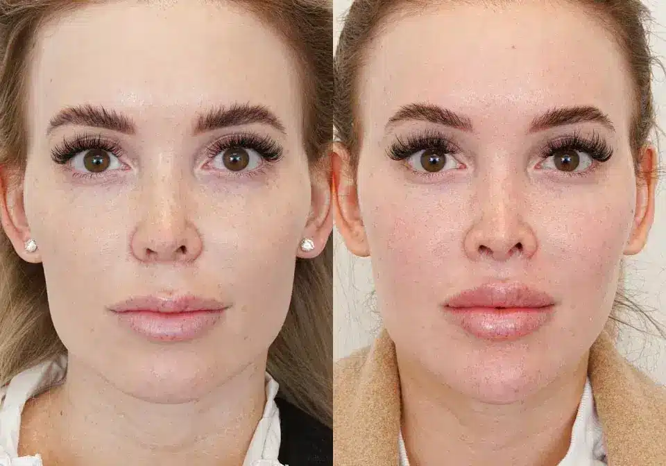 lip-lift-before-and-after