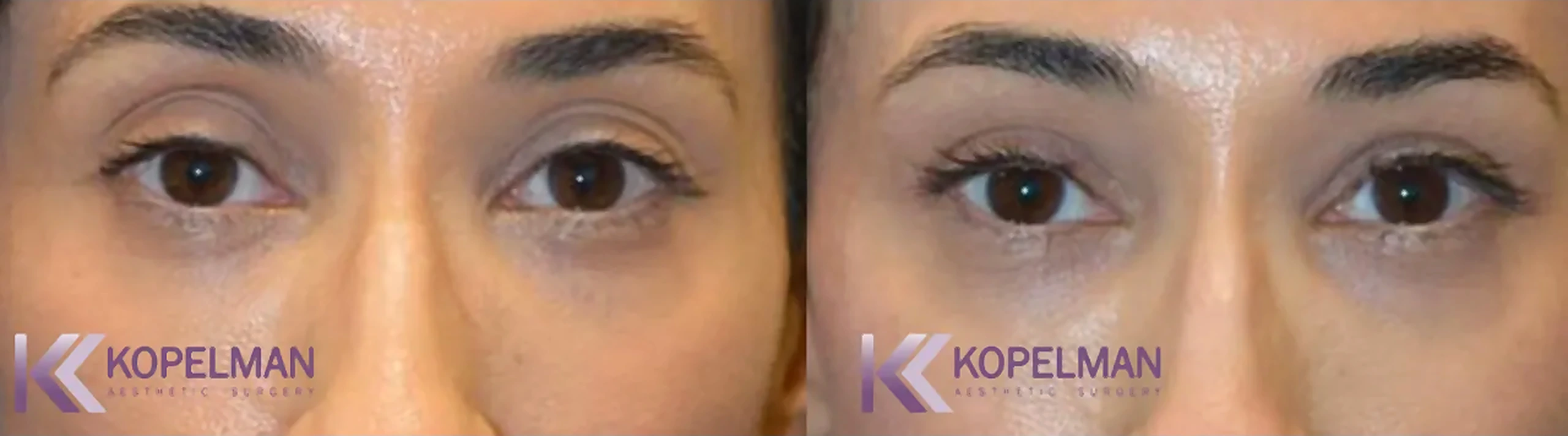 before-and-after-female-blepharoplasty-surgery-2_result-1