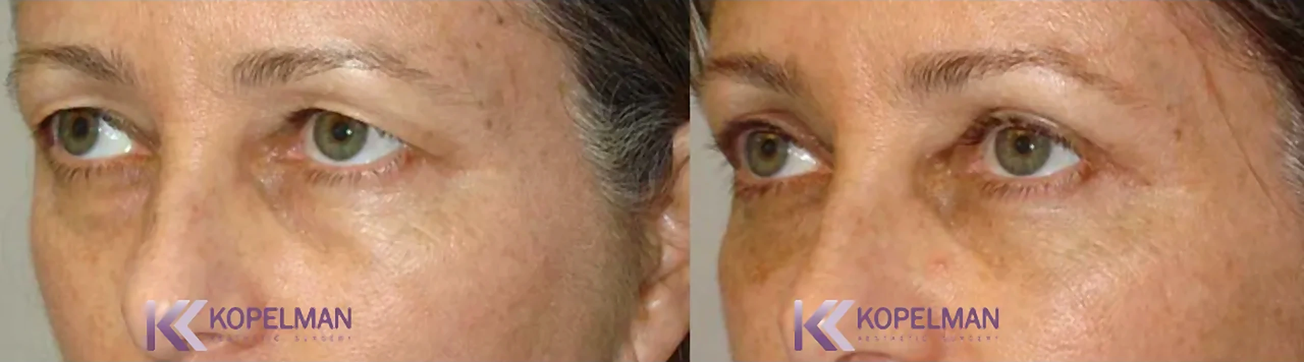 before-and-after-female-blepharoplasty-surgery-4_result-1