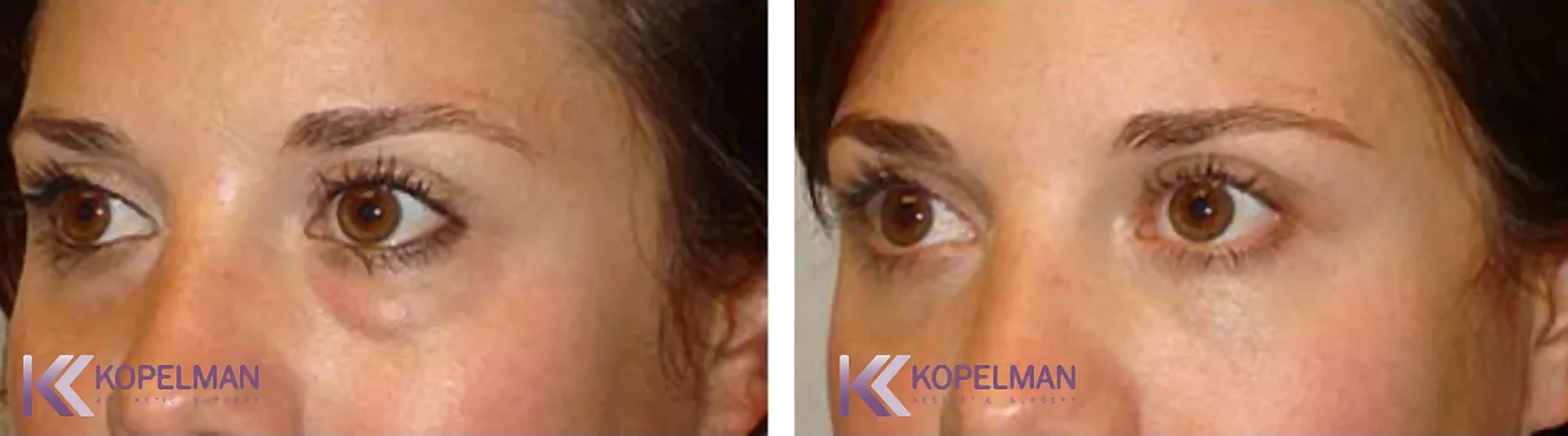 before-and-after-female-blepharoplasty-surgery_result-1