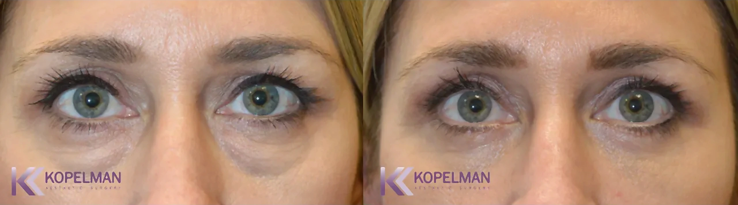 before-and-after-female-eyelid-surgery-2_result-1