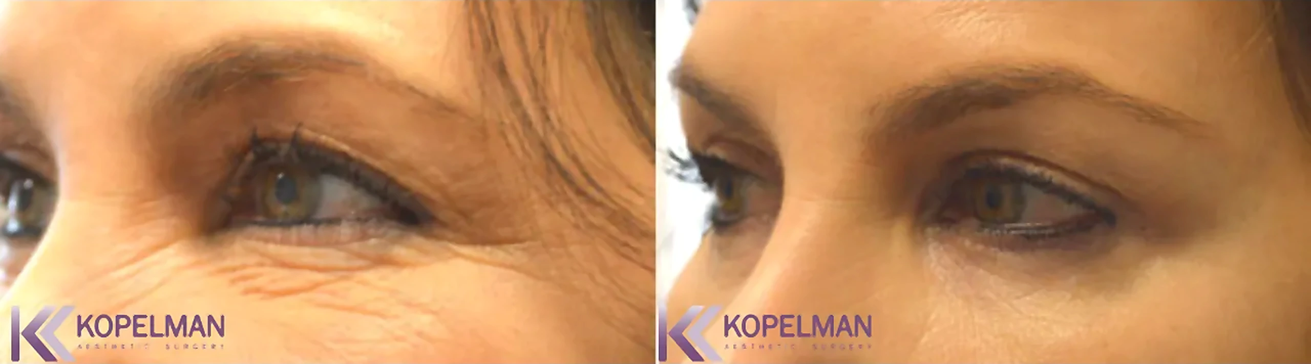 before-and-after-female-eyelid-surgery_result-2