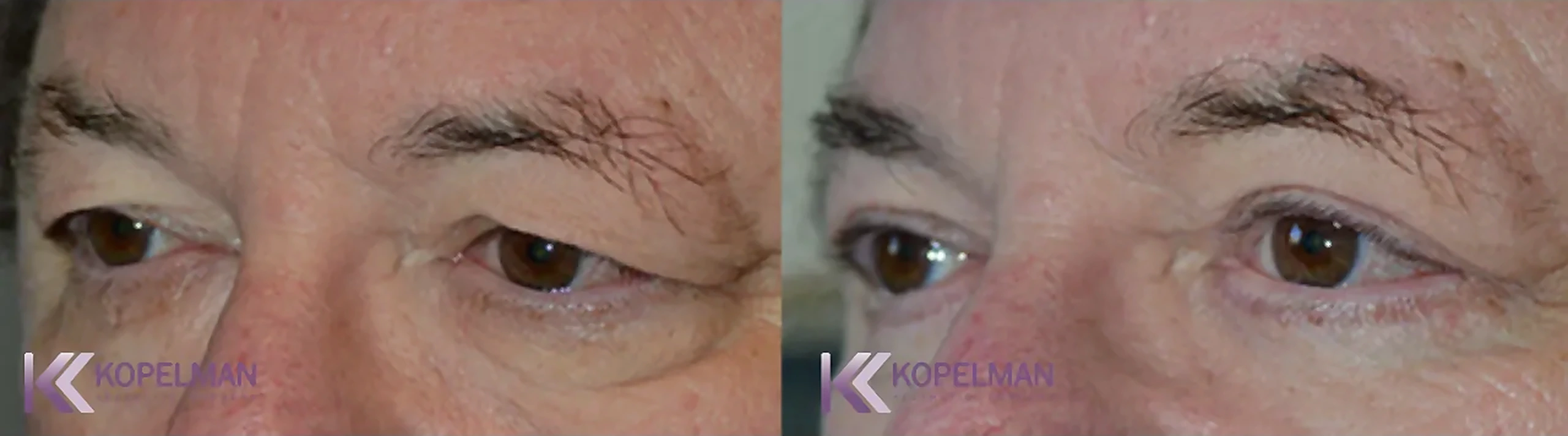 before-and-after-male-eyelid-surgery_result-2